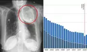 Shocking Medical Scan Reveals The Hidden Damage Of Tuberculosis Treatment