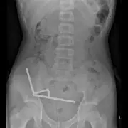 Teen's Horror E-Scooter Crash Sparks Major Surgery After Wheel Detaches Mid-Ride