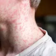 UK Health Alert: Deadly Meningitis Outbreak Sparks Urgent Warning Across Britain