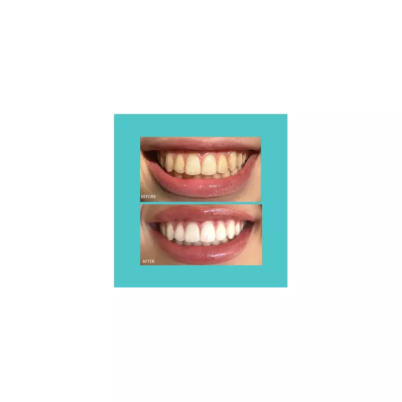 Award-Winning Teeth Whitening Kit Removes Tea Stains 'On First Try'