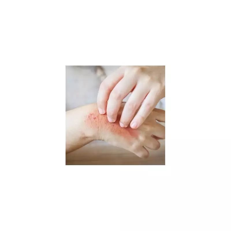 NHS Breakthrough: Revolutionary New Eczema Treatment Offers Hope to Thousands