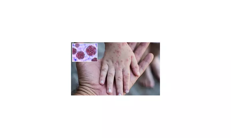 US HFMD Cases Surge: 1 Million Predicted in Unprecedented Outbreak