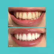 Award-Winning Teeth Whitening Kit Removes Tea Stains 'On First Try'