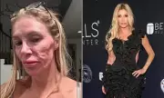 Brandi Glanville's £130k Parasite Ordeal: A 'Fresh Start' After Facial Disfigurement