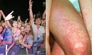 Deadly Meningococcal Outbreak: Health Experts Warn Schoolies Teens