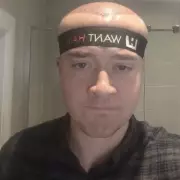 Man's Head Swells to Megamind Size After £3,500 Hair Transplant