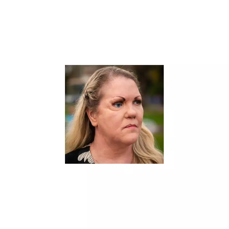 Car Crash Survivor's MRSA Nightmare: Infection 'Ate My New Face'