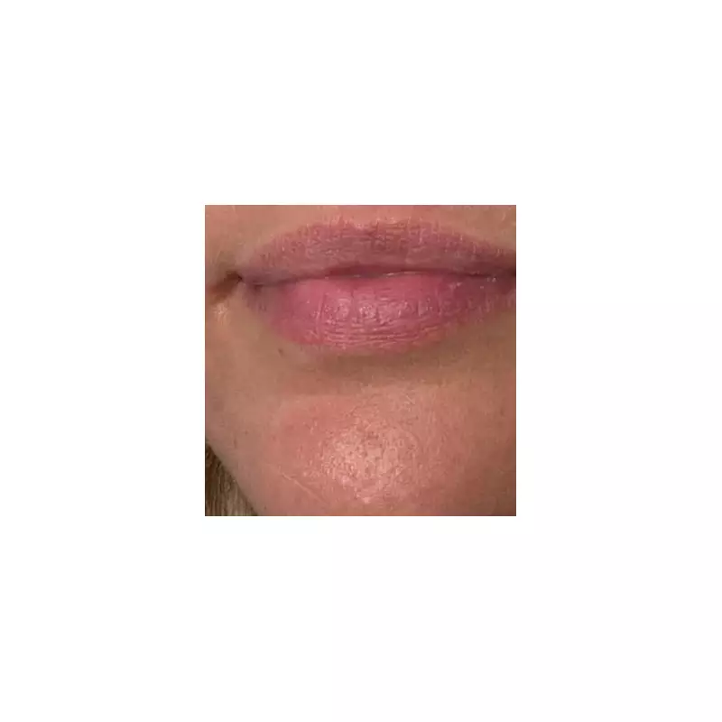 Dermatologist's Roller Gel Transforms Acne Treatment, Users 'Don't Know How I Lived Without It'