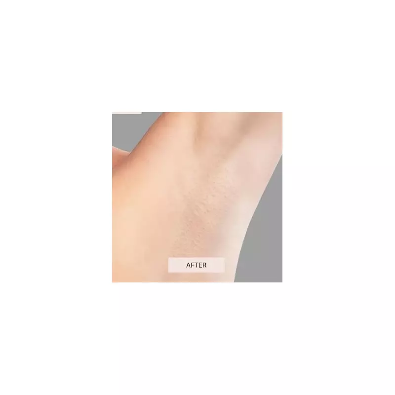 Keskine's 'Holy Grail' IPL Hair Removal Device Hits Record Low Price of £149.25