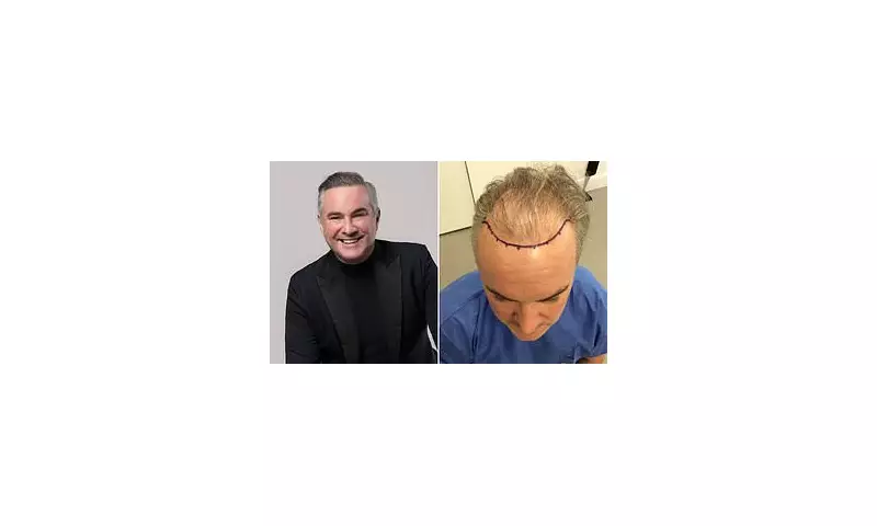 Nick Ede's Hair Transplant Journey: From Suicidal Thoughts to Joy at 50