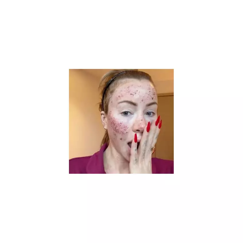 Olivia Attwood's Bloodied Face After CO2 Laser Shocks Fans & Husband Bradley Dack