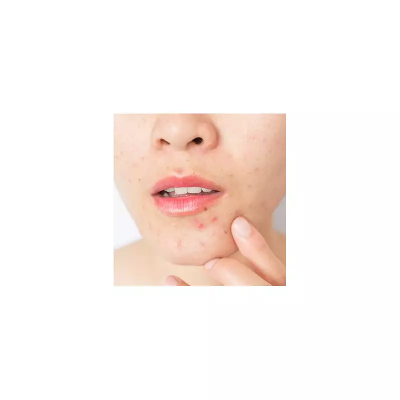 Skincare Expert's 5 Festive Breakout Fixes: Ditch Harsh Cleansers