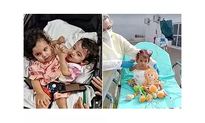Conjoined Twin Aruna Dies Months After 19-Hour Separation Surgery
