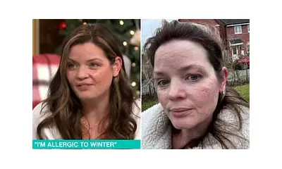 This Morning Guest Reveals Rare Allergy to Cold: 'My Skin Feels Like It's On Fire'