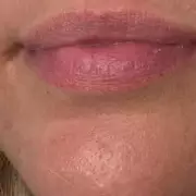 Dermatologist's Roller Gel Transforms Acne Treatment, Users Say 'Don't Know How I Lived Without'