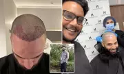 London Emerges as New Hair Transplant Hub for Americans, Challenging Turkey's Dominance