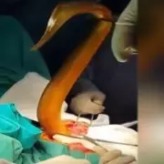 Man's emergency surgery after live eel eats through bowel in bizarre sex act
