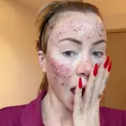 Olivia Attwood's Bloodied Face After CO2 Laser Shocks Fans & Husband Bradley Dack