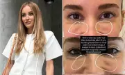 Rebecca Judd's 10-Year Eye Filler Journey: Dissolving, Surgery & Regrets