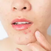 Skincare Expert's 5 Festive Breakout Fixes: Ditch Harsh Cleansers