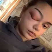 Teen's cold turned into deadly brain infection needing emergency surgery