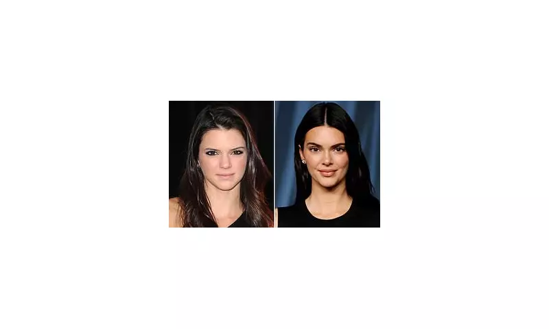 Kendall Jenner Denies Facial Surgery, Admits Only to Baby Botox
