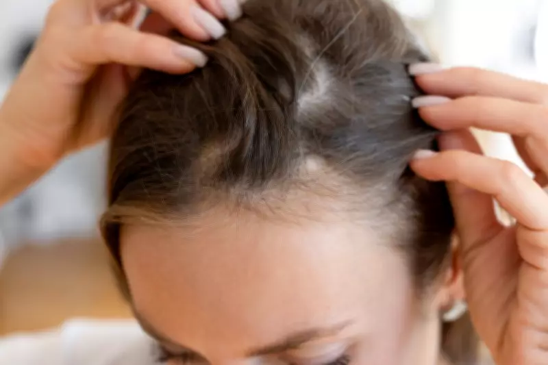 Landmark Tax Tribunal Ruling Classifies Baldness as Disability for Women