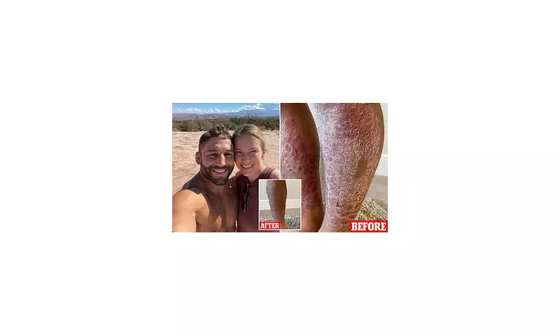 MMA Fighter's Psoriasis Clears on Animal-Based Diet: A UK Health Story