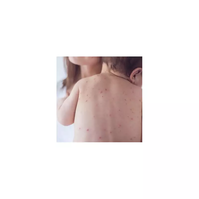 NHS Launches Chickenpox Vaccine in 'Historic Milestone' for Child Health