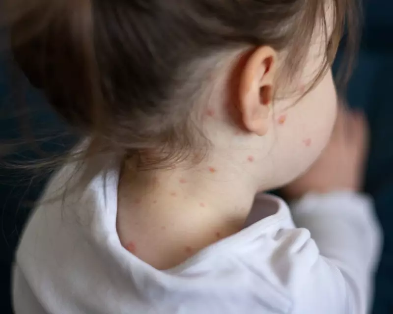NHS Launches New MMRV Vaccine to Protect Children from Chickenpox Complications