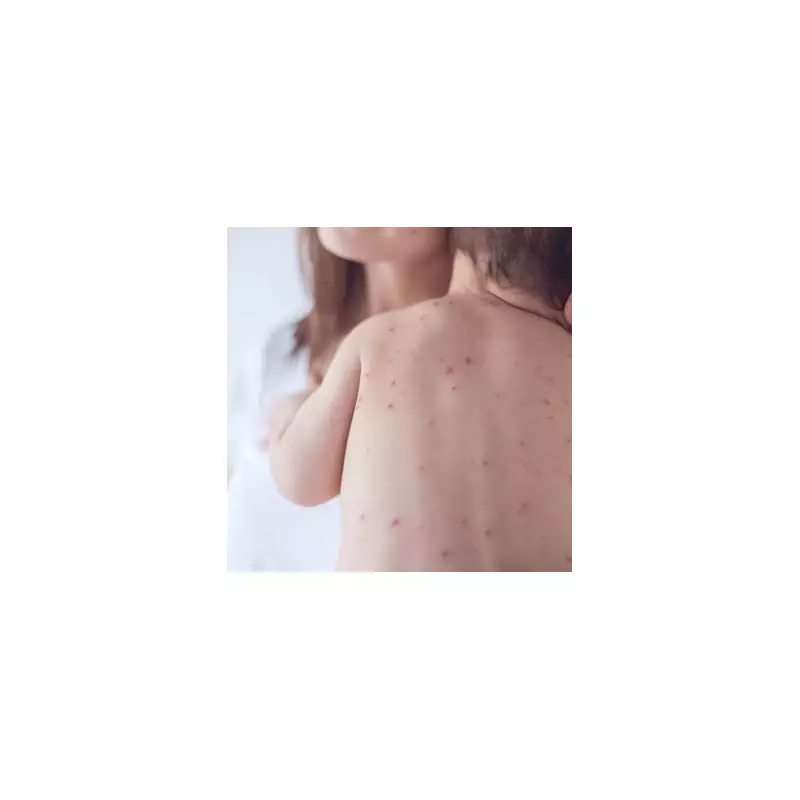 NHS Rolls Out New MMRV Vaccine: How Your Child Can Get Chickenpox Jab