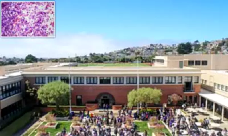 Third TB Case Confirmed at California Private School, Declaring Outbreak