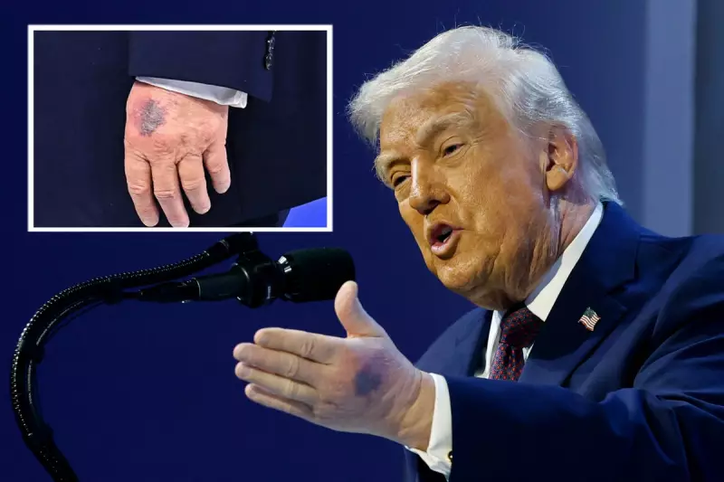 Trump's Bruised Hand Draws Attention During Davos 'Gaza Peace Board' Speech