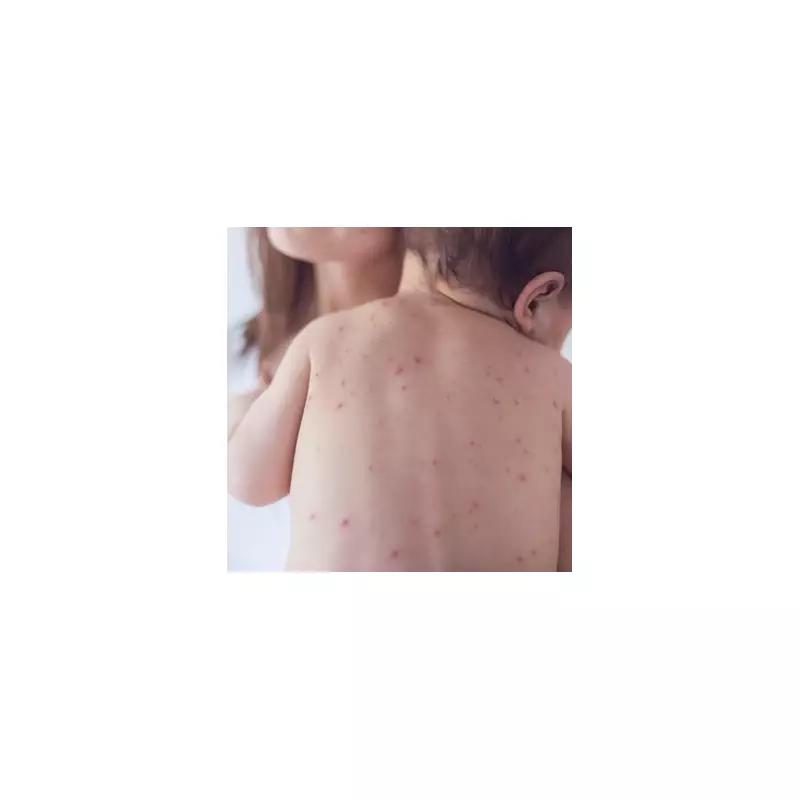 UK Loses Measles-Free Status as Cases Surge Nationwide - Check Your Local Area