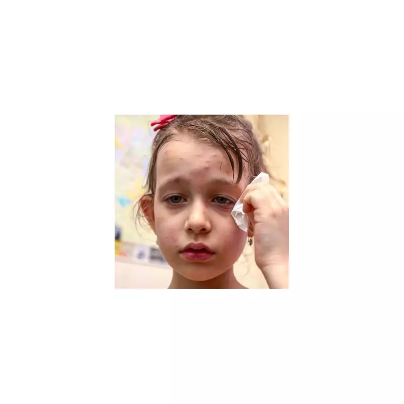 WHO Declares Measles 'Re-Established' in UK as Vaccination Rates Hit Decade Low