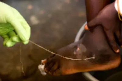 Guinea Worm Nears Eradication With Just 10 Human Cases Reported in 2025