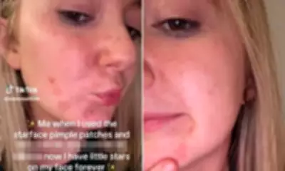 Starface Pimple Patches Leave Painful Marks as 'Sephora Kids' Skincare Trend Raises Alarm