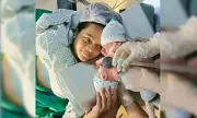 Conjoined Twins Die After Emergency Separation Surgery in Brazil