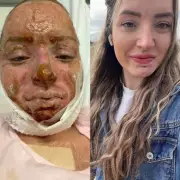 Cousins' Birthday Pub Trip Turns to Horror as Heater Explosion Causes Severe Facial Burns