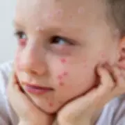 Impetigo Warning: Highly Contagious Skin Infection Often Confused with Eczema