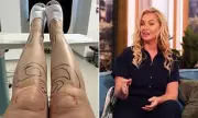 Josie Gibson's £7,000 Surgery for Lipoedema After Fans Spotted 'Typical Body'