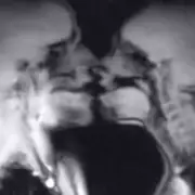 MRI Sex Study Uncovers Baffling Bladder Phenomenon During Intercourse