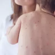 New NHS MMRV Vaccine: How Your Child Gets Chickenpox Jab After MMR