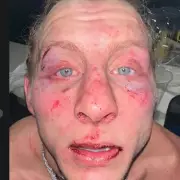 Paddy Pimblett Displays Facial Injuries Following Gruelling Gaethje Defeat at UFC 324