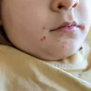 Superdrug Pharmacist Issues 'Stay Home' Alert Over Misdiagnosed Skin Infection