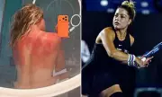 Tennis Star's Sunburn Warning: Australian UV Levels 'No Joke'