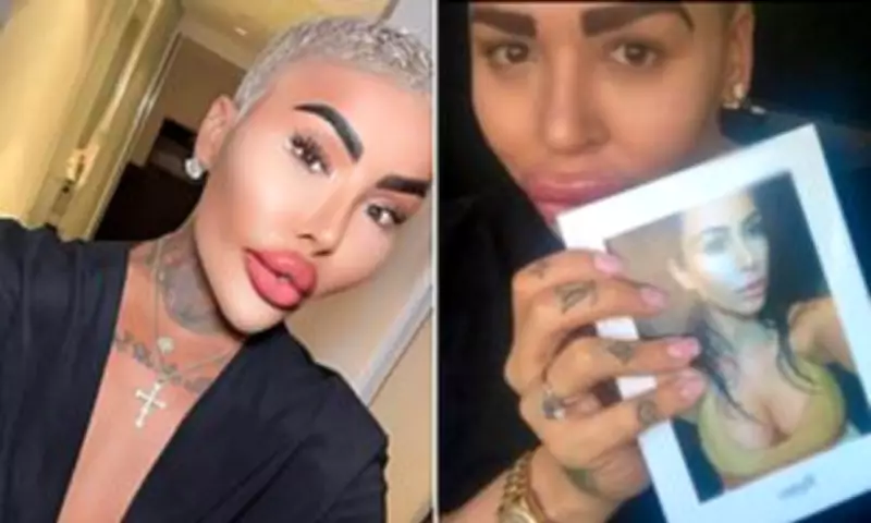 Britain's 'Lip King' Jordan James Parke Dies After 50+ Surgeries