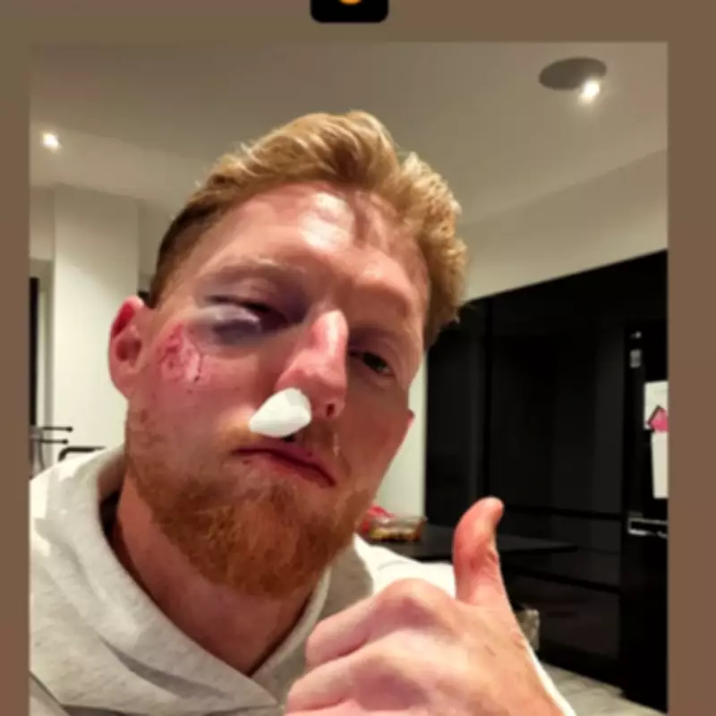 England Captain Ben Stokes Reveals Facial Injury After Cricket Ball Mishap