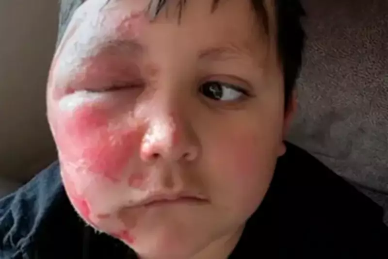 Illinois Boy Hospitalised After TikTok Toy Trend Causes Severe Facial Burns