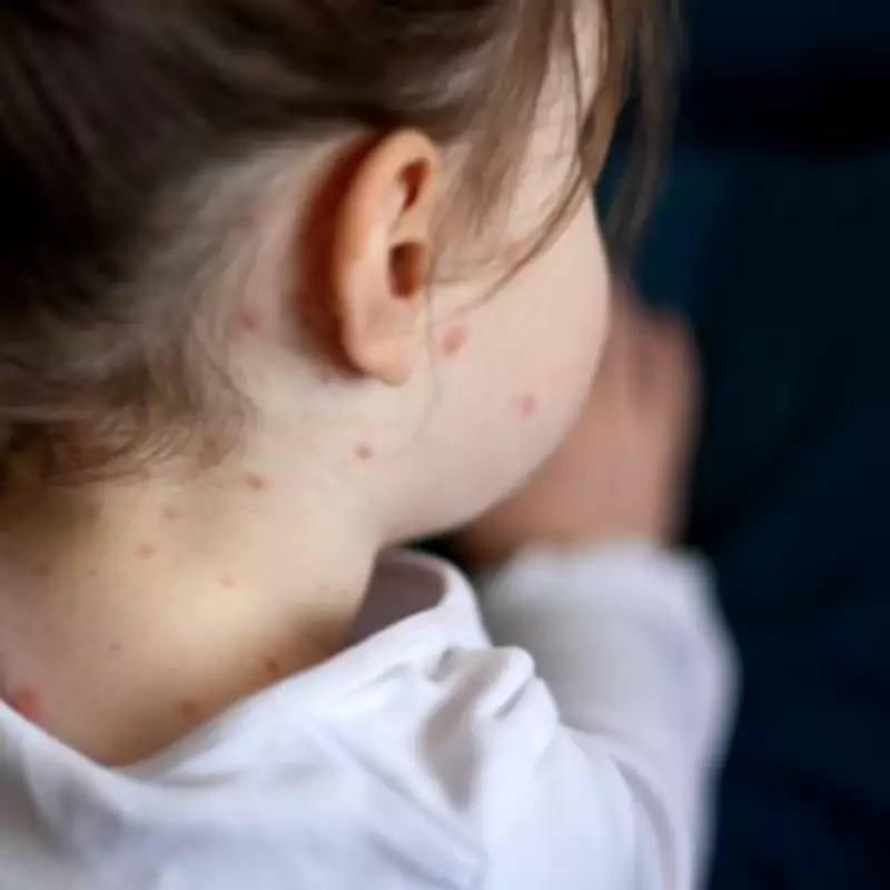 Major Measles Outbreak Hits London Schools: Parents Urged to Check Vaccinations